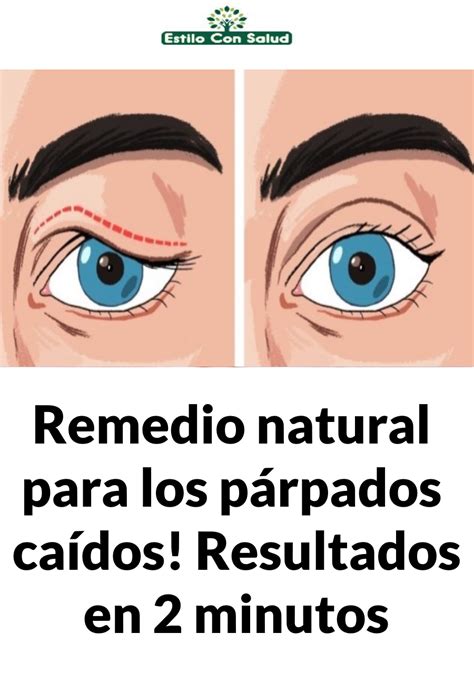 Remedio natural para los párpados caídos Resultados en 2 minutos en