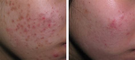 Acne & Acne Scars | Before & After | Kingsway Dermatology