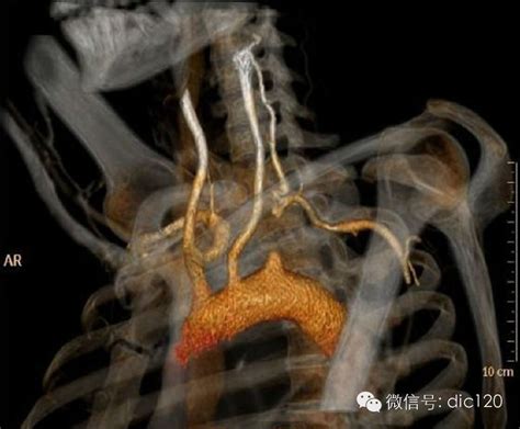 锁骨下动脉窃血综合征 Medscicn