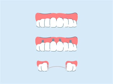 Types of Dentures and Cost: Everything You Need to Know | SNOW® Oral Care