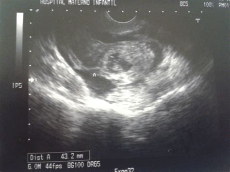 Transvaginal Scan Embryonic Structures In Tubal Ectopic Pregnancy Download Scientific Diagram