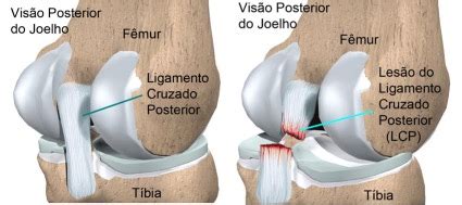 Lesão do Ligamento Cruzado Posterior Dr Leonardo Rocha Thomaz