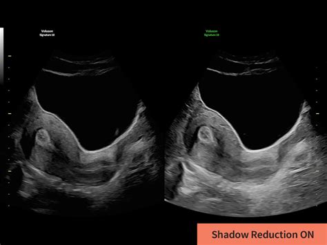 Voluson Signature 18 For Women S Health Ultrasound Ge Healthcare