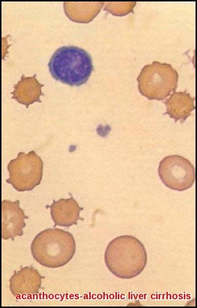 Acanthocytosis Ask Hematologist Understand Hematology Medical