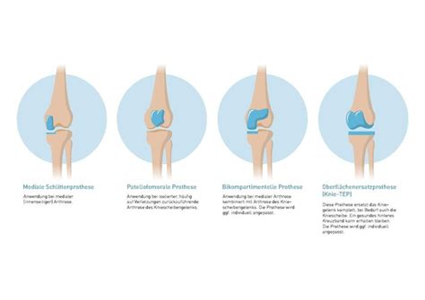 Knieprothese Definition Arten Operation Reha