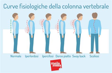 Scoliosi Che Cos Classificazioni Cause Sintomi E Cura Melarossa