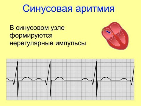 Синусовая аритмия сердца: что это, симптомы, лечение, чем опасна