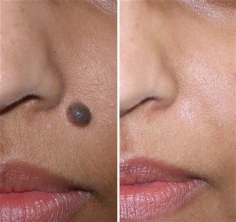 Healthy and Beauty Tips: Mole Removals | Treatment for Moles