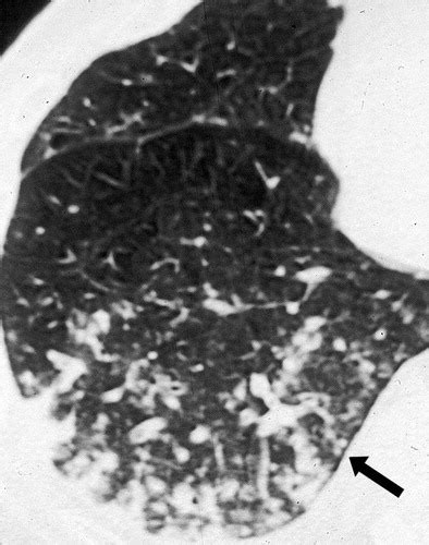 Tree In Bud Pattern At Thin Section CT Of The Lungs Radiologic