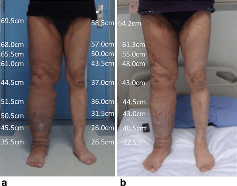 The Patient A 55 Year Old Male Had Secondary Lymphedema Of The Right