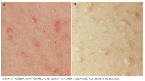 Poison Oak Rash On Lips Lipstutorial Org