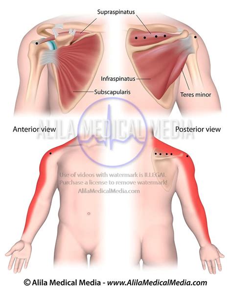 Supraspinatus Trigger Points