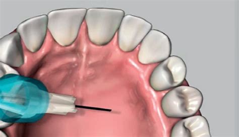 Periodontologia Znieczulenie Amsa Wykonane Wand Najnowsze