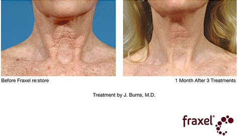 Fraxel Laser Before And After - change comin