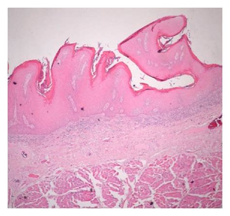 Photomicrograph Of Verrucous Hyperplasia Showing Sharp Surface