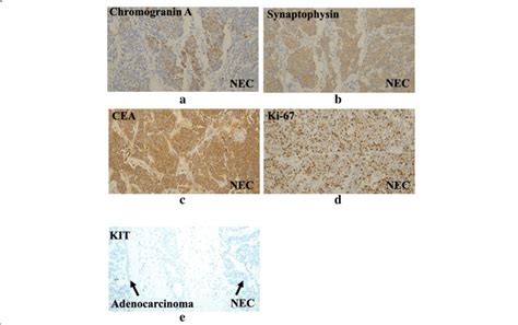 Immunohistochemical Staining Of The Nec Revealed Positive Staining For