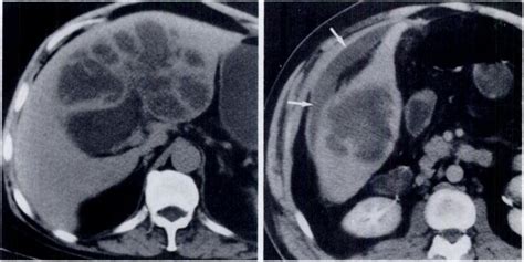 Enhanced Ct Scan Shows Amebic Liver Abscess Inferlorly In Right Lobe Download Scientific