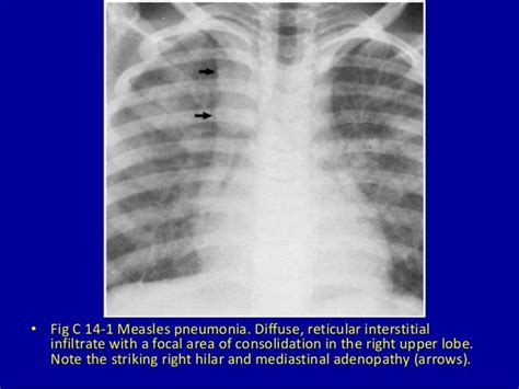 14 hilar and mediastinal lymph node enlargement