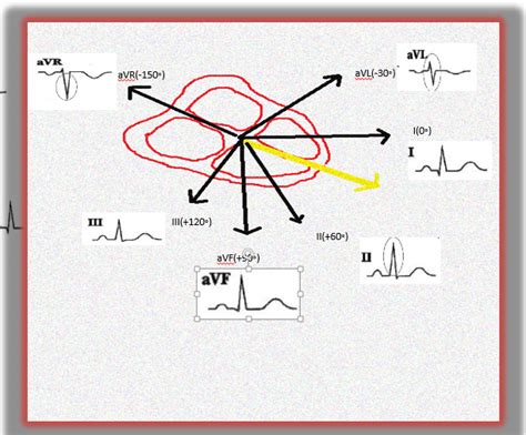 pay attention   augmented vector  avr ekg lead