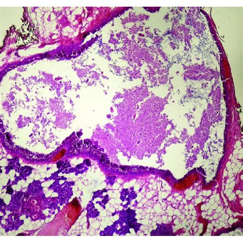 Histopathologic Slide Of Intermediate Grade Mucoepidermoid Carcinoma Of Download Scientific