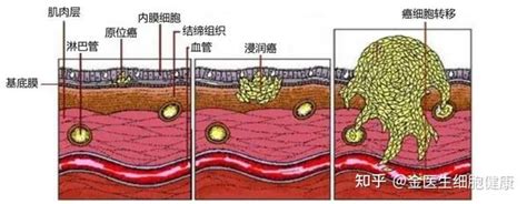 免疫50时代，如何从本质上预防肿瘤术后复发和转移？ 知乎