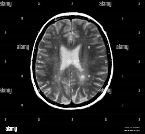 Lyme Encephalopathy Axial Magnetic Resonance Imaging Mri Scan Of The