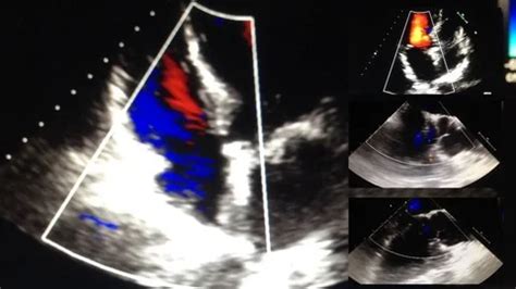 Echocardiography (ultrasound examination... | Stock Video | Pond5