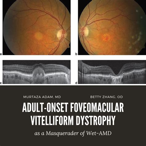 Adult Onset Foveomacular Vitelliform Dystrophy As A Masquerader Of Wet Macular Degeneration