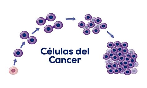 Identifican el mecanismo que hace que el cáncer cree metástasis