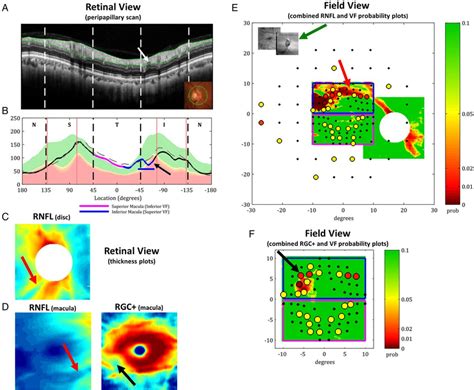 The Single Page Spectral Domain Optical Coherence Tomography Report For