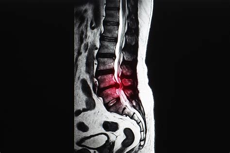 Radiculopathy Radiculitis The Orthopedic Pain Institute Beverly