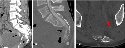 Figure 2 From Rectothecal Fistula Complicating Anterior Sacral