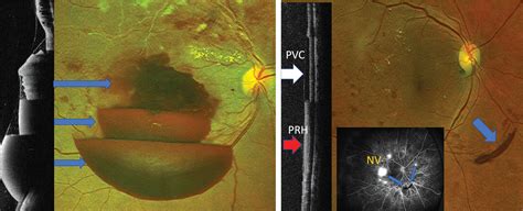 Identifying Diabetic Retinopathy Biomarkers With Oct Optometric Management