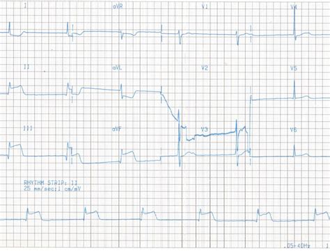 Bradycardias Case 1 Rcemlearning India