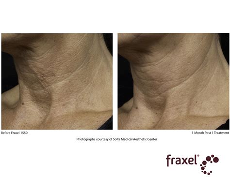 Fraxel Laser Treatment Cost Results Studiomd Midtown Manhattan Nyc