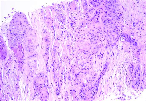 Biopsy Of The Supraclavicular Node Under Low Power Field Download Scientific Diagram