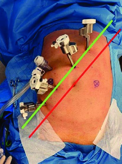 Trocar Placement Site For Robotic Rectal Surgery Download Scientific