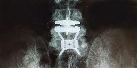 Total Disc Replacement Surgery - Brain & Spine Surgeons of New York