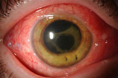 Moran CORE Neovascularization Of The Iris Rubeosis Iridis