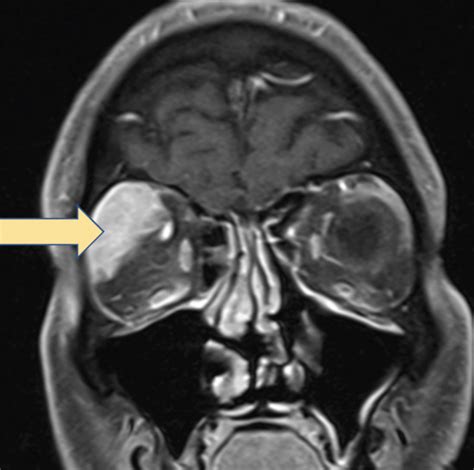Lesson Keeping An Eye Out For Lacrimal Gland Abnormalities