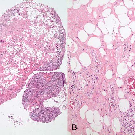 A And B Papillary Synovial Projections Composed Of Mature Adipocytes