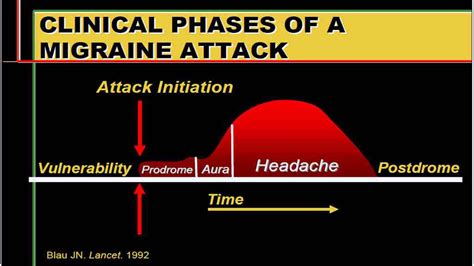 Stages Of A Migraine