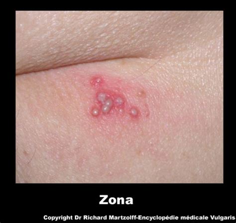 Image Photo Zona Dermatologie Vulgaris Médical