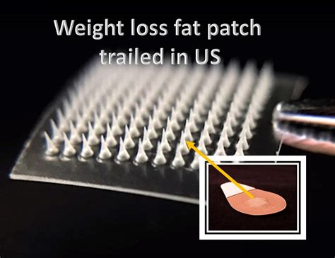 Weight loss Fat Patch is trialled in US - HealthyLife | WeRIndia