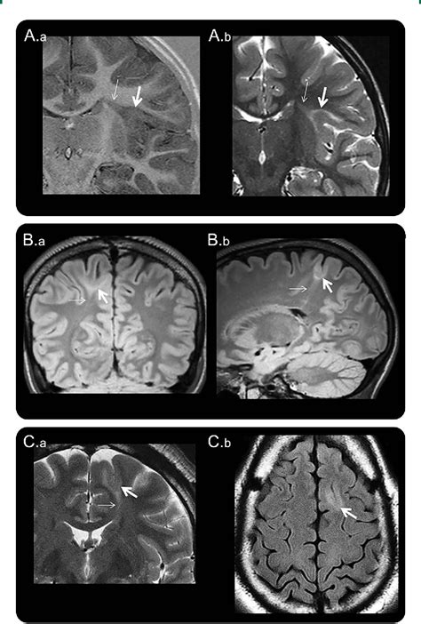 Figure From The Surgically Remediable Syndrome Of Epilepsy Associated