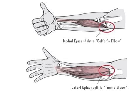 Tennis Elbow And Golfers Elbow What Is The Difference Orthomed Canada