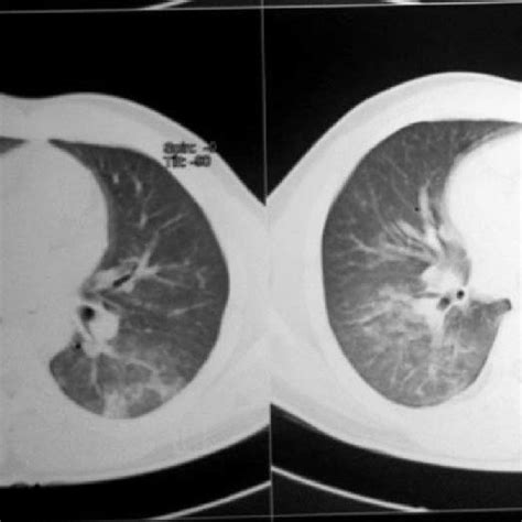 E CT Chest Showing Patchy Ground Glass Opacity And Air Space