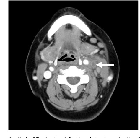 Figure From Internal Jugular Vein Thrombosis Secondary To Acupuncture