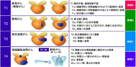 前立腺がん いかど腎泌尿器科クリニック・松本市