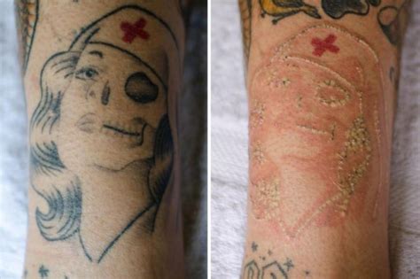 Eliminar tatuajes con láser realmente es efectiva esta técnica